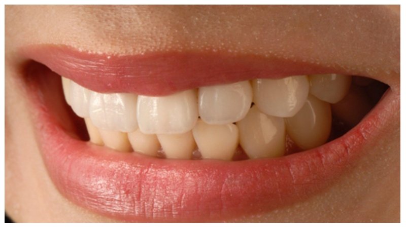 Permanent Tooth Replacement