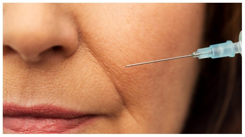 Dermal Filler Treatments