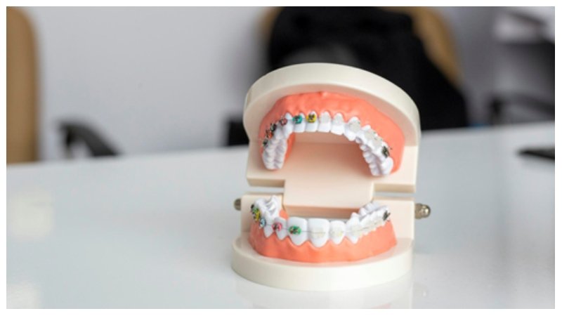 Teeth Straightening Braces