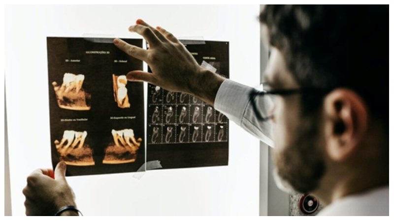 Full-Arch Dental Implants